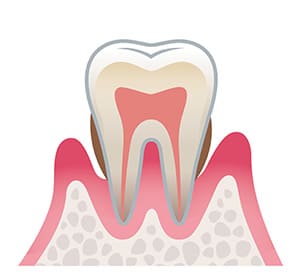 中度歯周病