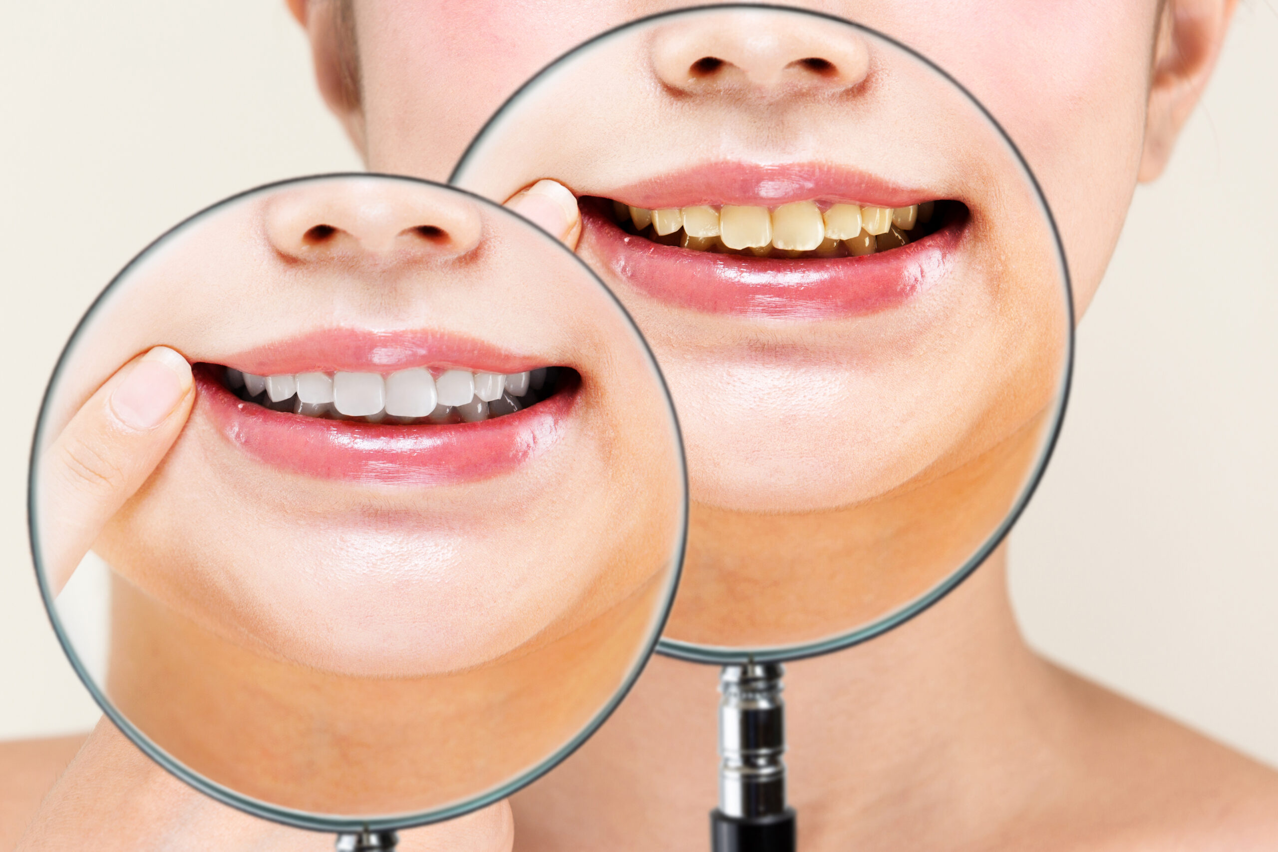 歯の黄ばみが気になる方へ